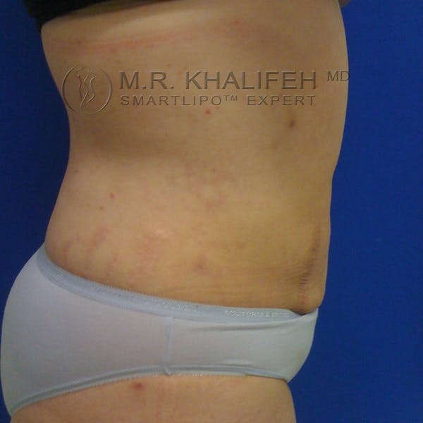 Abdominal Liposuction Gallery - Patient 3776737 - Image 4
