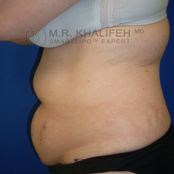 Abdominal Liposuction Gallery - Patient 3776737 - Image 5