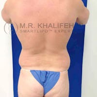 Male Liposuction Gallery - Patient 3776769 - Image 1