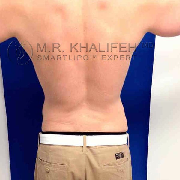 Male Liposuction Gallery - Patient 3776769 - Image 2