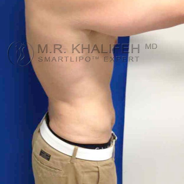 Male Liposuction Gallery - Patient 3776769 - Image 4