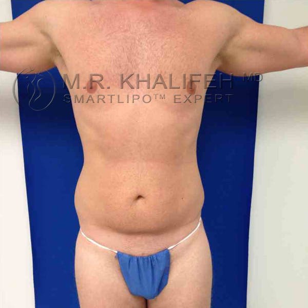 Male Liposuction Gallery - Patient 3776769 - Image 5