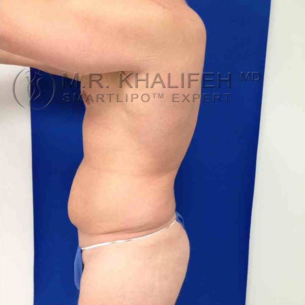 Male Liposuction Gallery - Patient 3776769 - Image 7