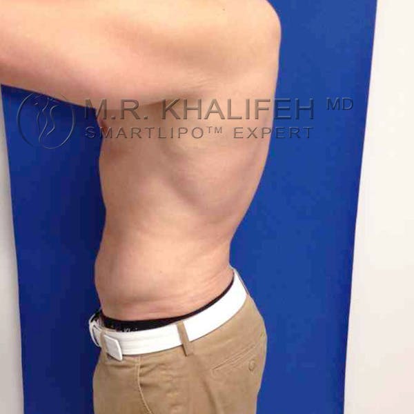 Male Liposuction Gallery - Patient 3776769 - Image 8