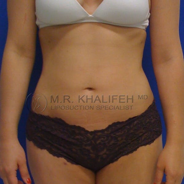 Abdominal Liposuction Gallery - Patient 3776804 - Image 2
