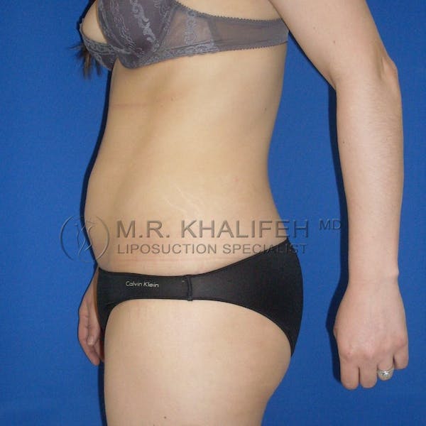 Abdominal Liposuction Gallery - Patient 3776804 - Image 3