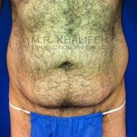 Male Liposuction Gallery - Patient 3776859 - Image 1