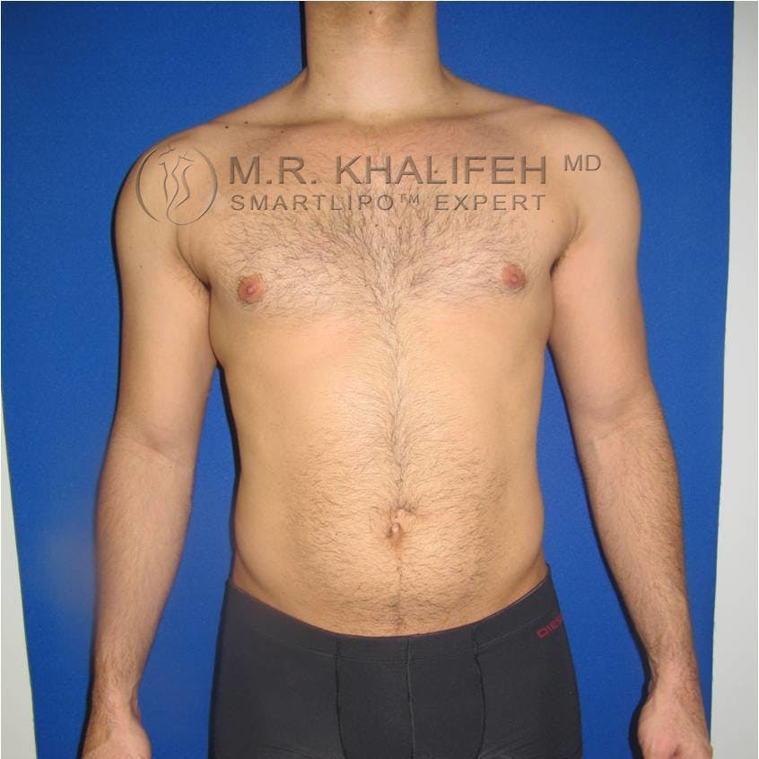Abdominal Liposuction Gallery - Patient 3776893 - Image 1