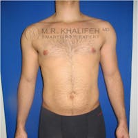 Abdominal Liposuction Gallery - Patient 3776893 - Image 1