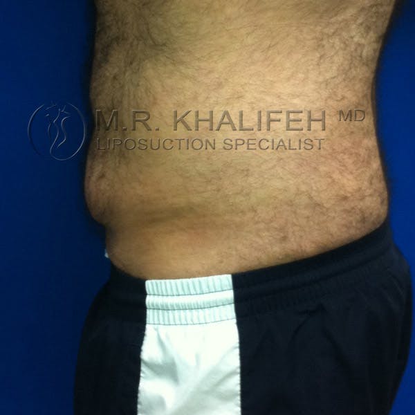 Male Liposuction Gallery - Patient 3776859 - Image 4