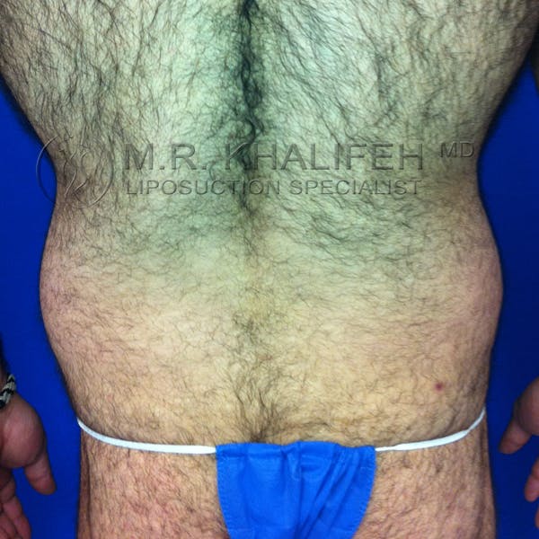 Male Liposuction Gallery - Patient 3776859 - Image 5