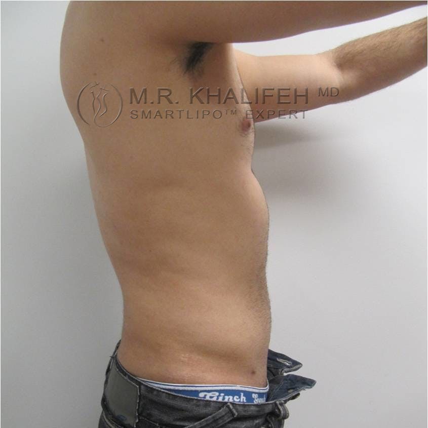 Abdominal Liposuction Gallery - Patient 3776893 - Image 4