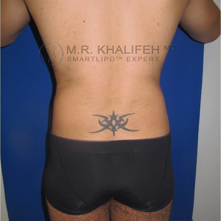 Abdominal Liposuction Gallery - Patient 3776893 - Image 7