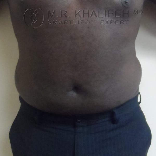 Male Liposuction Gallery - Patient 3776953 - Image 2