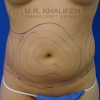 Abdominal Liposuction Gallery - Patient 3776944 - Image 1