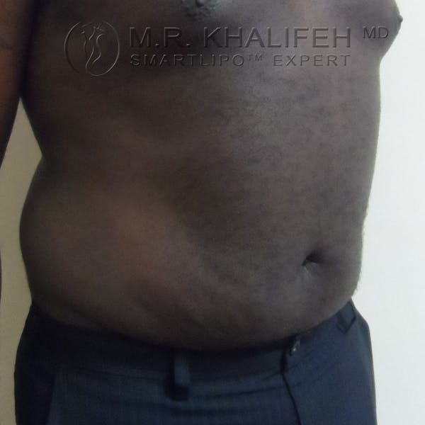 Male Liposuction Gallery - Patient 3776953 - Image 4