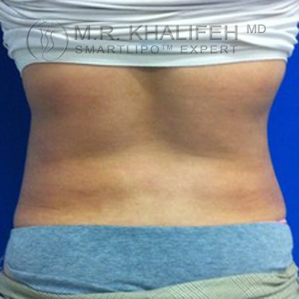 Abdominal Liposuction Gallery - Patient 3776944 - Image 4