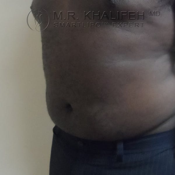 Male Liposuction Gallery - Patient 3776953 - Image 8