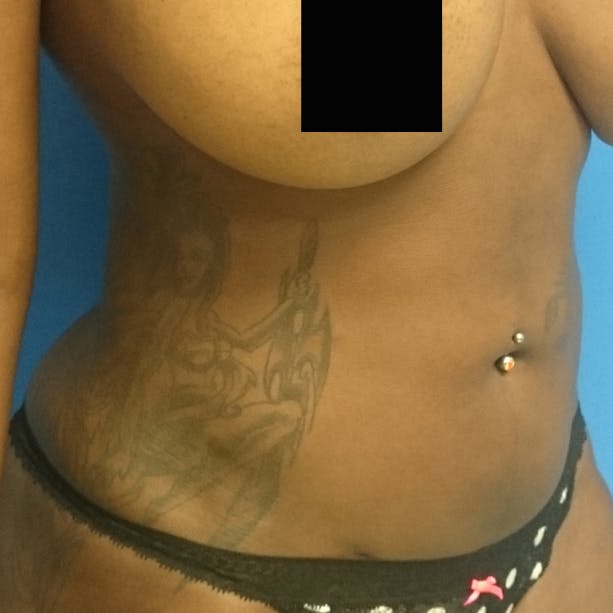 Abdominal Liposuction Gallery - Patient 3777027 - Image 4