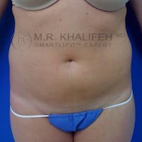 Abdominal Liposuction Gallery - Patient 3777070 - Image 1
