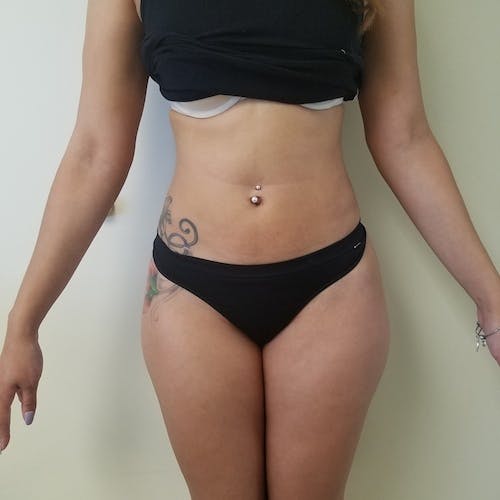 Abdominal Liposuction Gallery - Patient 3777132 - Image 2