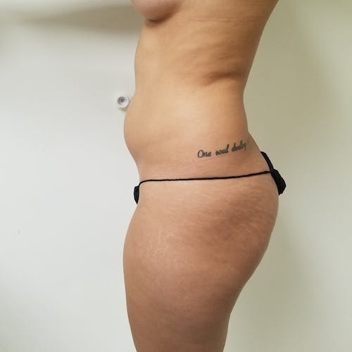 Abdominal Liposuction Gallery - Patient 3777132 - Image 7