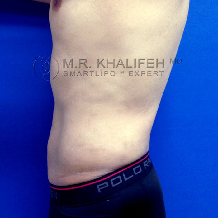 Male Liposuction Gallery - Patient 3777168 - Image 6