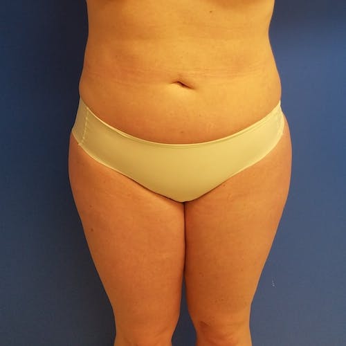 Abdominal Liposuction Gallery - Patient 3777200 - Image 2