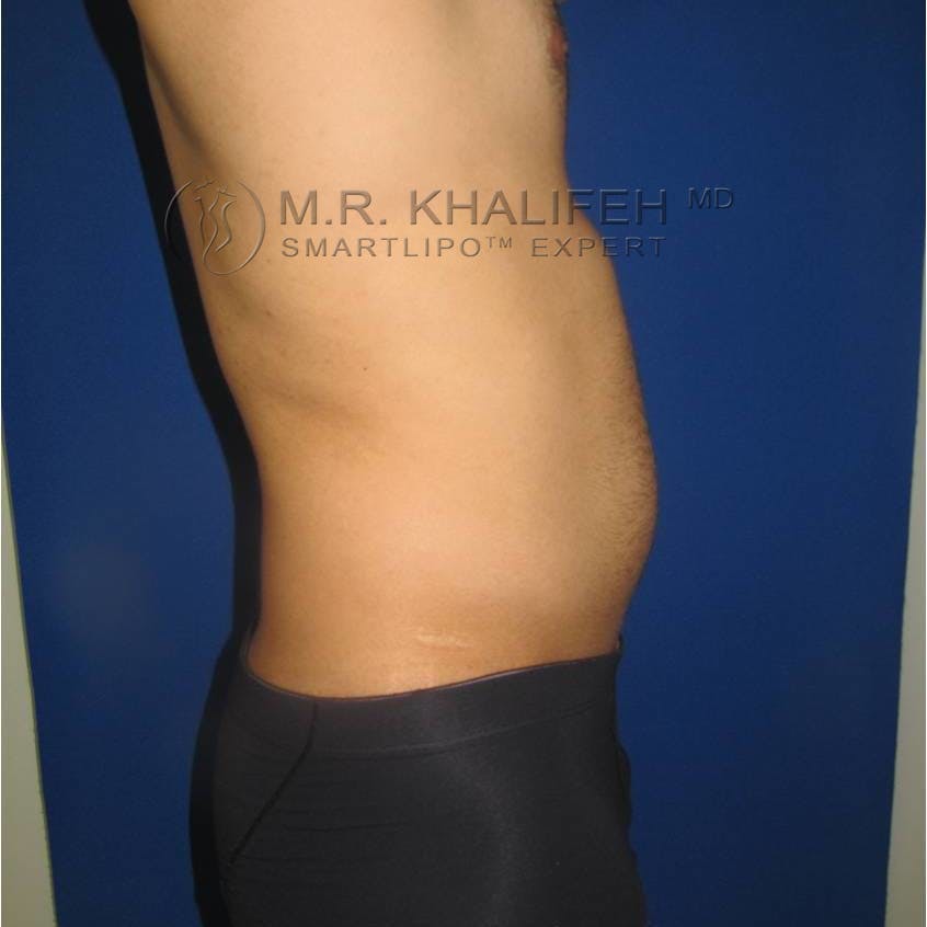 Male Liposuction Gallery - Patient 3777213 - Image 3