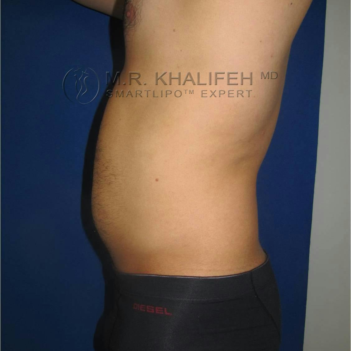 Male Liposuction Gallery - Patient 3777213 - Image 5
