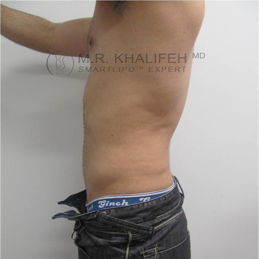 Male Liposuction Gallery - Patient 3777213 - Image 6
