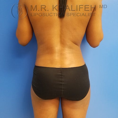 Abdominal Liposuction Gallery - Patient 3777221 - Image 4