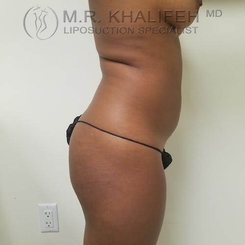 Abdominal Liposuction Gallery - Patient 3777221 - Image 7