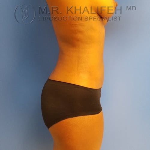 Abdominal Liposuction Gallery - Patient 3777221 - Image 8