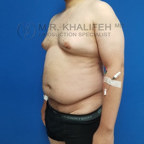 Male Liposuction Gallery - Patient 3819372 - Image 7