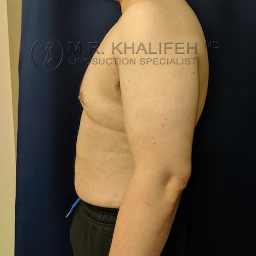 Male Liposuction Gallery - Patient 3819372 - Image 10