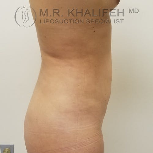 Abdominal Liposuction Gallery - Patient 3819632 - Image 6