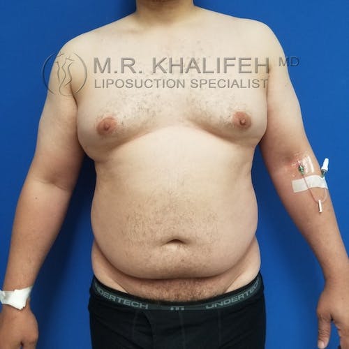Abdominal Liposuction Gallery - Patient 3819829 - Image 1