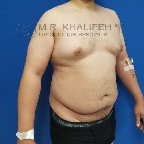 Abdominal Liposuction Gallery - Patient 3819829 - Image 3
