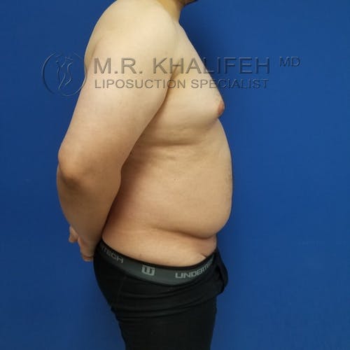 Abdominal Liposuction Gallery - Patient 3819829 - Image 5