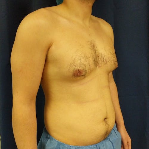 Gynecomastia Gallery - Patient 3820801 - Image 3