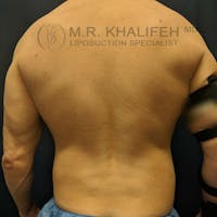 Male Liposuction Gallery - Patient 3821724 - Image 1