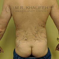 Male Liposuction Gallery - Patient 3821793 - Image 1