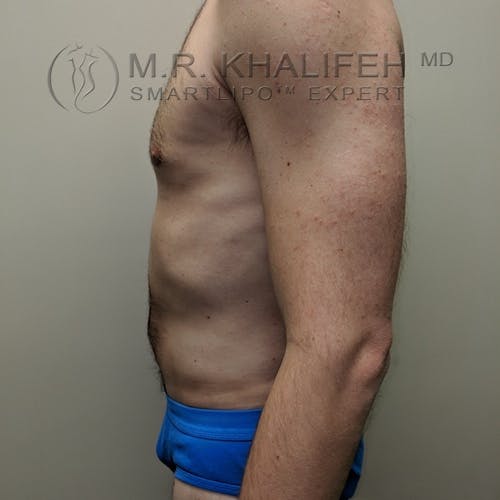 Male Liposuction Gallery - Patient 3821793 - Image 6