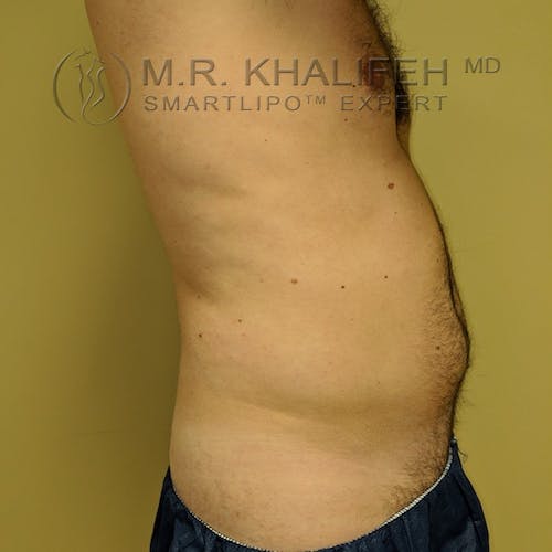 Male Liposuction Gallery - Patient 3821793 - Image 7
