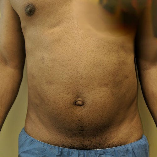Male Liposuction Gallery - Patient 3821895 - Image 3