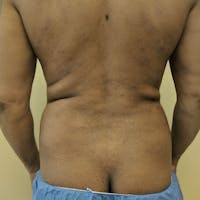 Male Liposuction Gallery - Patient 3821895 - Image 1
