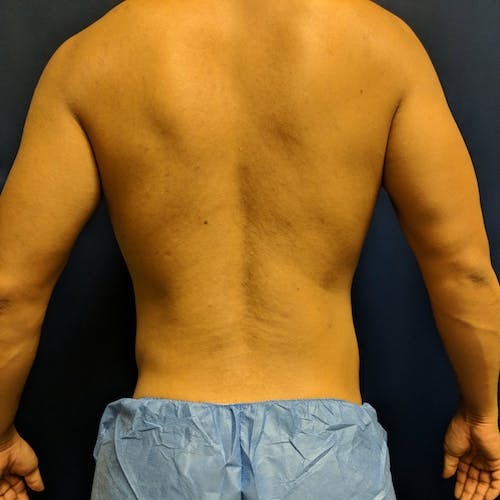 Male Liposuction Gallery - Patient 3821969 - Image 2