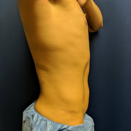 Male Liposuction Gallery - Patient 3821969 - Image 6