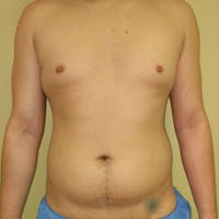 Male Liposuction Gallery - Patient 3821983 - Image 1